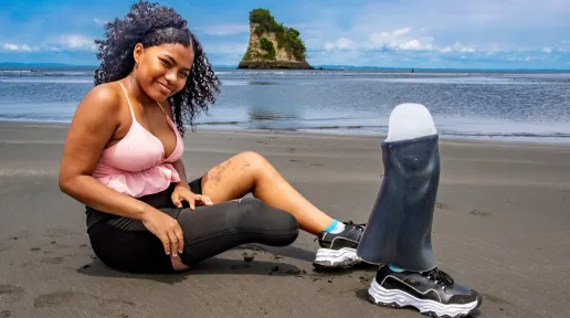 Maribel, víctima de minas antipersonal, en una playa mostrando su pierna afectada y su prótesis.